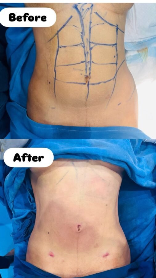 Liposuction in Islamabad - Dr. Ahmed Ali